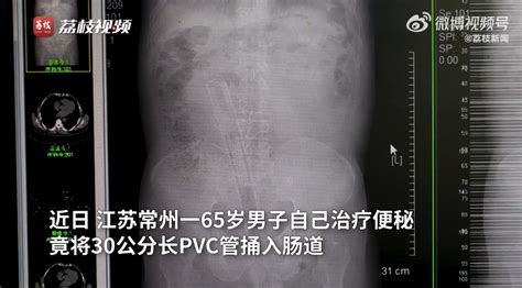 大叔「肛門插一根」痛到送院 30厘米膠管「頂到肝臟」 原因曝光｜醫師easy