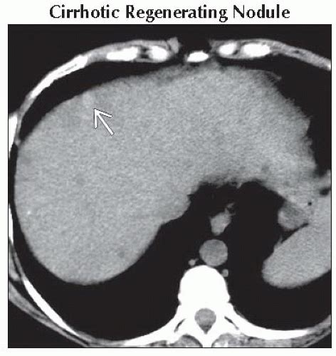 Da Db Focal Hyperdense Hepatic Mass On Nonenhanced Ct Ffu