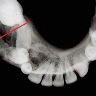 Axial Ct Scan Image Showing Well Defined Multilocular Radiolucency