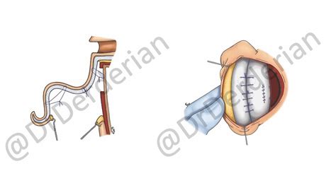 Otoplasty (Ear Surgery) — Dallas Plastic Surgeon specializing in Rhinoplasty, Septoplasty, Cleft ...