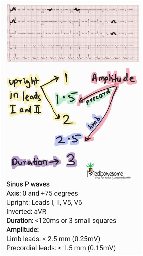 Medicowesome: Normal P wave ECG notes and mnemonic