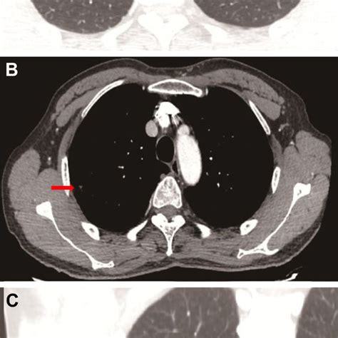 Chest Ct Scan Notes A Lung Window B Mediastinal Window C Download Scientific Diagram