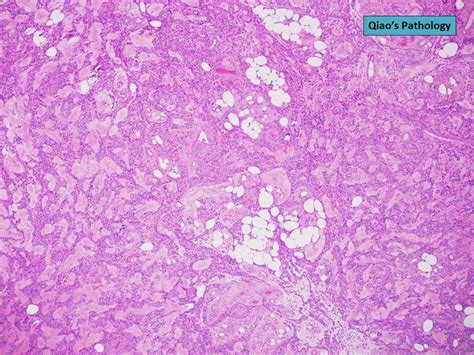 Qiao S Pathology Qiao S Pathology Angiolipoleiomyoma Of The Ovary A