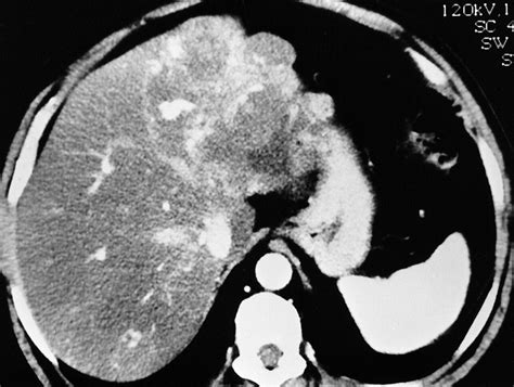 Imaging Of Atypical Hemangiomas Of The Liver With Pathologic Correlation Radiographics