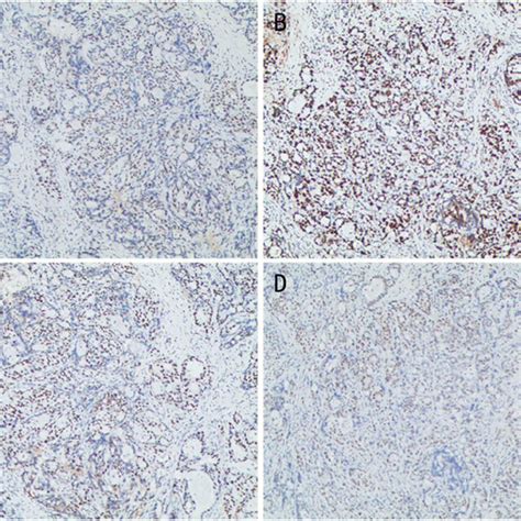 Immunohistochemistry Showed MLH A MSH2 B MSH6 C