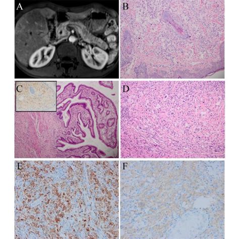 Radiological And Pathological Features Of Case A Chest Ct Showed A