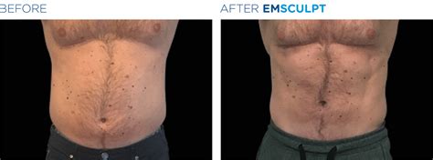 Emsculpt Neo In Bozeman Montana Ridgway Plastic Surgery Medical Spa