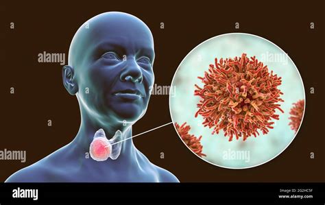 Thyroid Gland Cancer Illustration Stock Photo Alamy