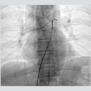 Fluoroscopic Image Of Catheter Fragment Fixation With The Loop Catheter