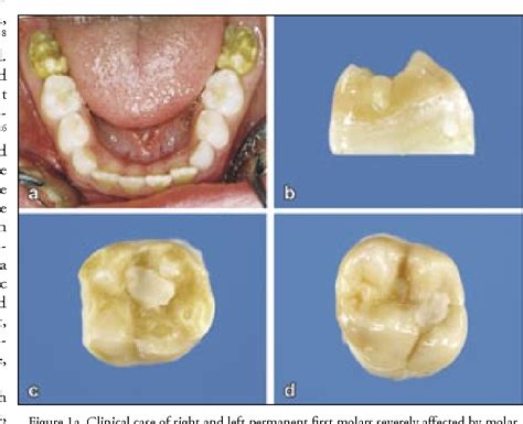 Pdf Molar Incisor Hypomineralization Review And Recommendations For