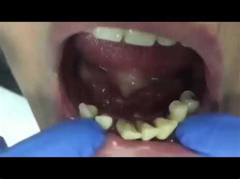 Movilidad Dental De Tercer Grado Youtube