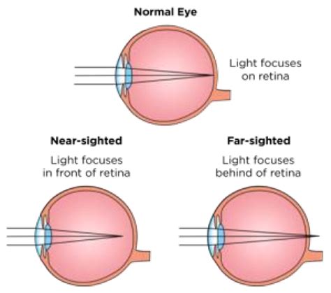 Myopia, Hyperopia, Presbyopia and Astigmatism. Image Source: 22 ...