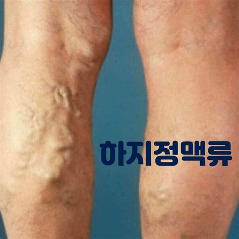 하지정맥류 치료 수술 후 회복 기간 스타몽블로그