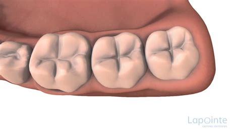 Scellants De Puits Et De Fissures Centres Dentaires Lapointe Youtube
