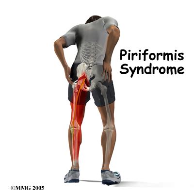 Piriformis Syndrome | 👨‍⚕️Singapore Orthopaedic & Neurosurgery Clinic