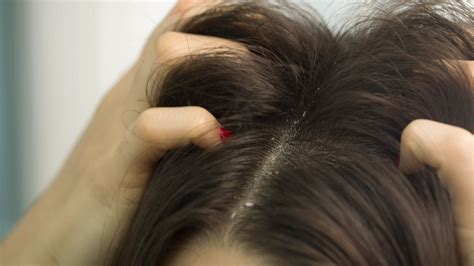 Watch 6 Common Dandruff Myths Self