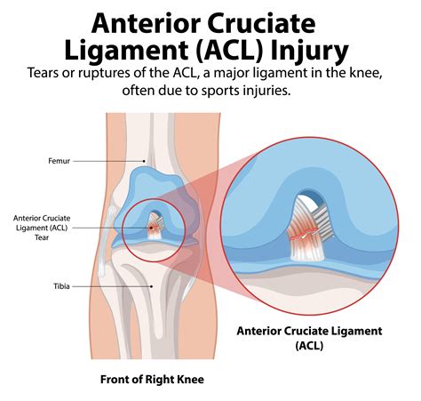 Anterior Cruciate Ligament (ACL) Injury | Symptoms & Treatment Options