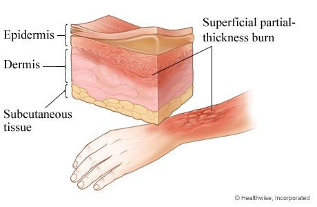 Nursing Care Of Patients With Burns Flashcards Quizlet