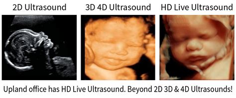 Ultrasounds Difference Between 3d And 4d Ultrasounds