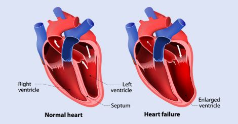 Congestive Heart Failure Symptoms in Men – Know the Signs