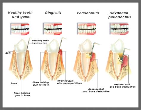 What Is Periodontitis Idw