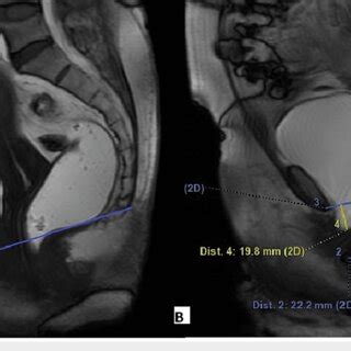 A 48 Year Old Female Complained Of Stress Incontinence And Incomplete