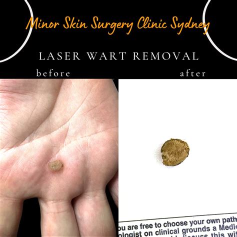 Laser Wart Removal & Treatment Sydney - Finger warts, Plantar warts ...