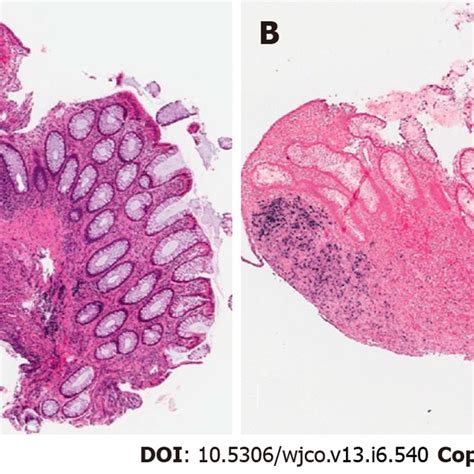 Epstein Barr Virus Associated Smooth Muscle Tumor In The Rectum In Case