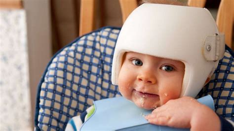 Does your baby need helmet therapy? 5 facts about flat head syndrome ...