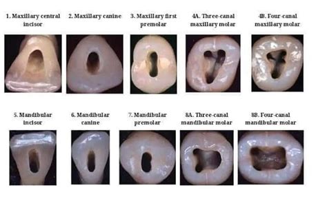 Access Cavity 🦷 B | Dental fillings, Dental help, Dental health care