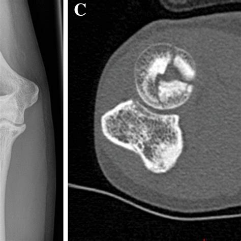 A B Postoperative Radiographs Anteroposterior And Lateral After