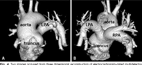 Figure 4 From Persistent Truncus Arteriosus With Aortic Dominance In Female Adult Patient