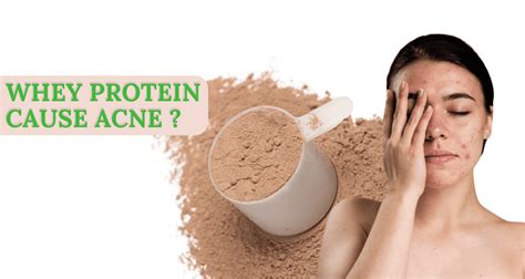 Does Whey Protein Cause Acne Know The Facts