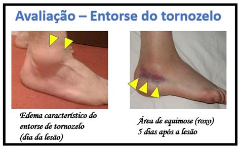 Quanto Tempo Leva Para Curar O Ligamento Quebrado Leia Aqui Quanto