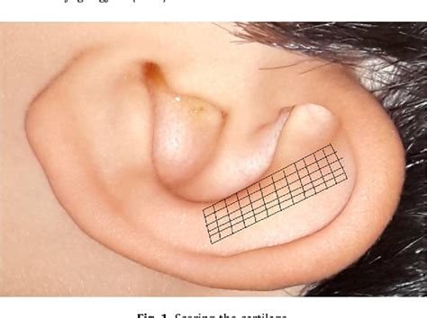 Figure 1 From Comparison Of Two Incisionless Otoplasty Techniques For