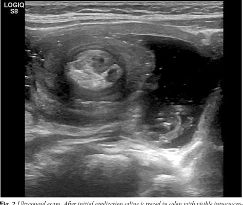 Figure 2 From Ultrasound Guided Reduction Of Ileocolic Intussusception