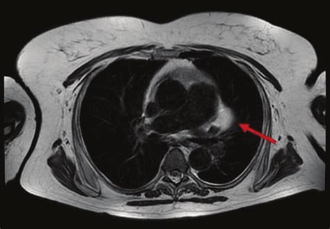 Chest Magnetic Resonance Imaging Axial Plane Is Confirmed The Pedicle