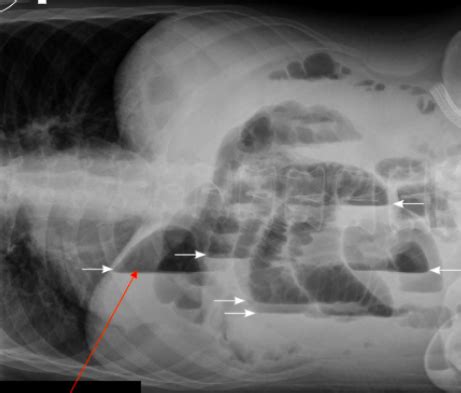 Projections And Pathology Monica Abdomen Flashcards Quizlet