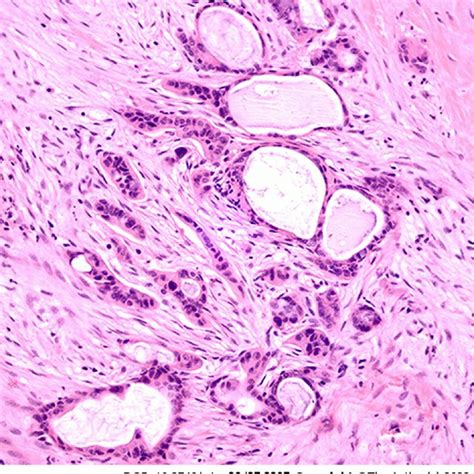 Pancreatic Ductal Adenocarcinoma With An Associated Tumor Download Scientific Diagram