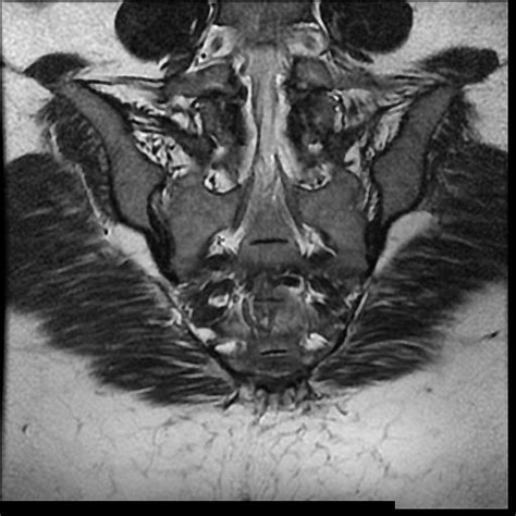 Isolated Lower Segment Transverse Sacral Fracture Image Radiopaedia Org