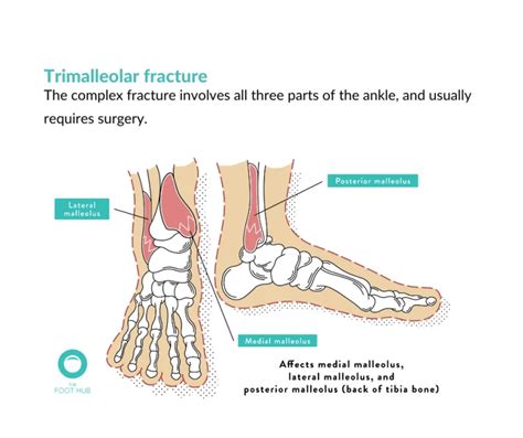 Fractured Ankle How To Treat Them And How To Recover From Them The