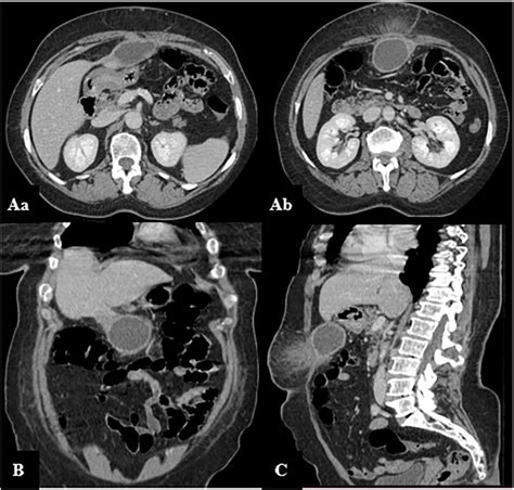 Computed Tomography Of The Abdomen In Axial Aa B Coronal B And