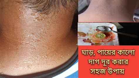 Neck Darkness Removed Home Remedy