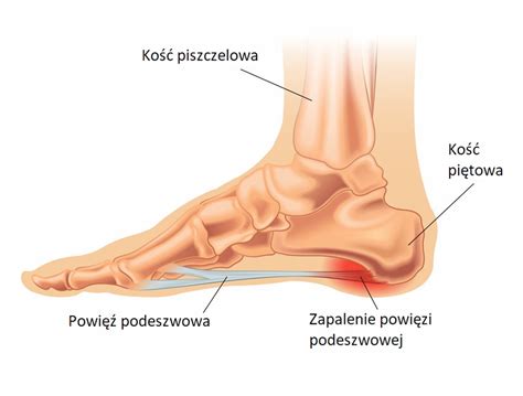 Ból pięty ostroga piętowa zapalenie powięzi podeszwowej Sklep