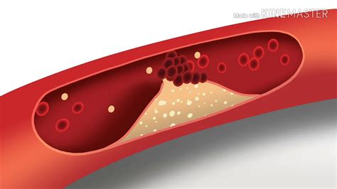 Hypertension The Silent Killer Youtube