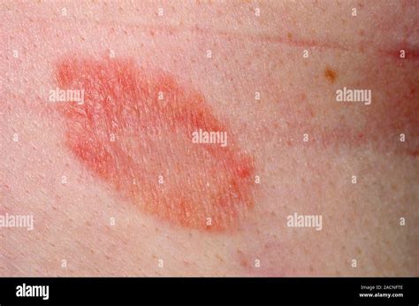 Close Up Of A Red Lesion Known As A Herald Patch On The Skin In A 40