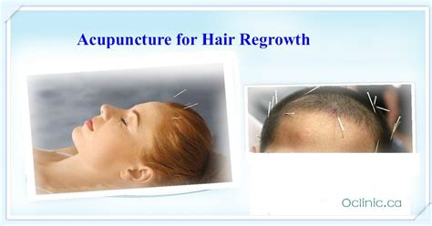 Acupuncture Massage Clinic Scarborough Acupuncture For Hair Loss Does It Work