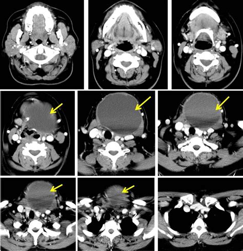 Thyroglossal Duct Cyst Radiology Cases