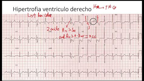 Hipertrofia Ventriculo Derecho YouTube