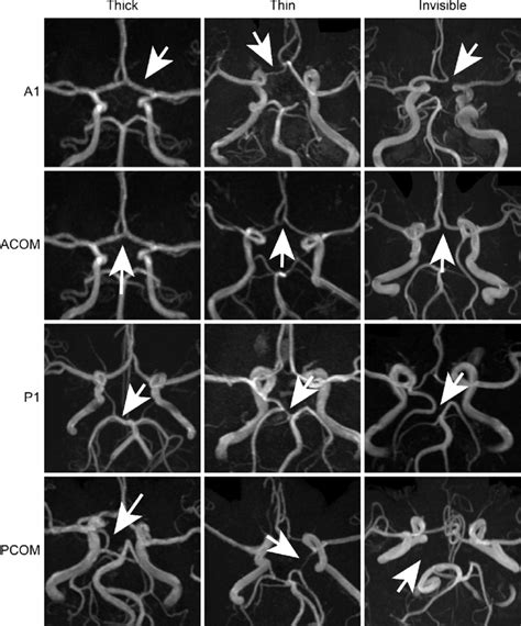 Definitions Of Vessel Thicknesses On Magnetic Resonance Angiography